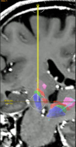 14. Oktober 2025 Patienten-Infonachmittag zur Tiefen Hirnstimulation